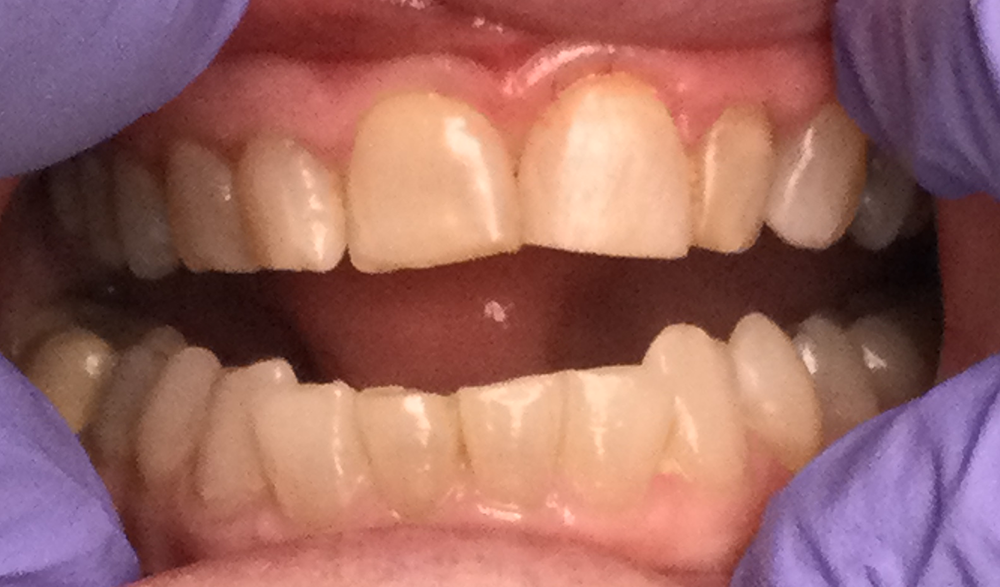 before